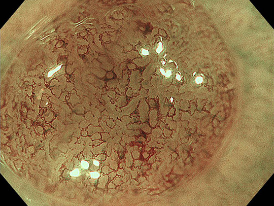大腸ポリープ（通常光）