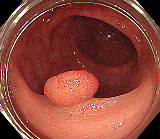 10mmの大腸ポリープ