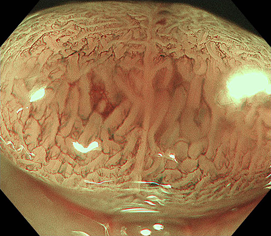 拡大観察で腺腫が疑われます