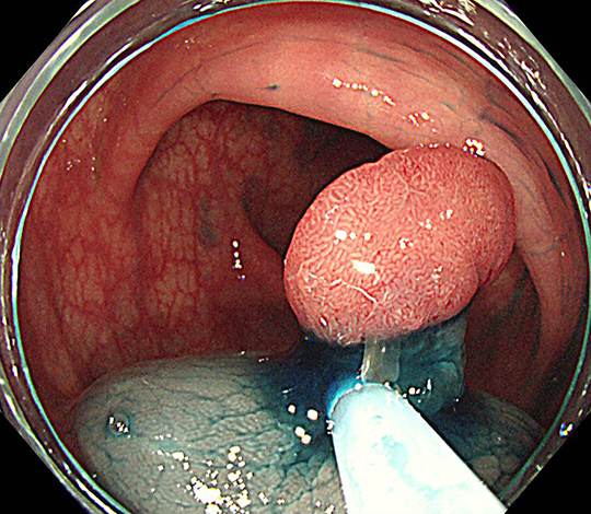 ポリープの根元を正常粘膜を含んでスネアで絞扼し切除します